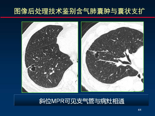 【PPT】肺实质与支气管——基本CT征象的定义与诠释