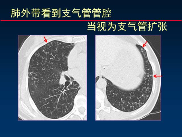 【PPT】肺实质与支气管——基本CT征象的定义与诠释