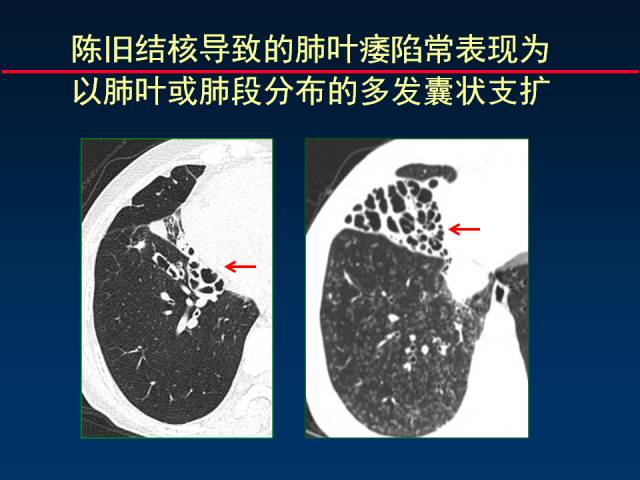 【PPT】肺实质与支气管——基本CT征象的定义与诠释