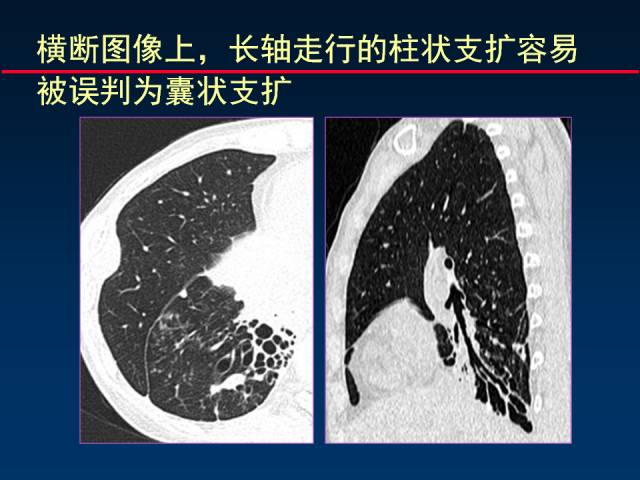 【PPT】肺实质与支气管——基本CT征象的定义与诠释