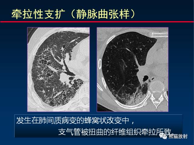 【PPT】肺实质与支气管——基本CT征象的定义与诠释