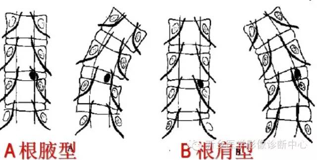 这样诊断“腰椎间盘突出”才更专业 这样诊断“腰椎间盘突出”才更专业