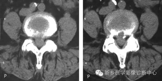 这样诊断“腰椎间盘突出”才更专业 这样诊断“腰椎间盘突出”才更专业