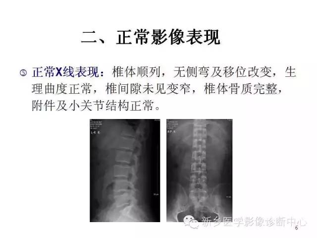 这样诊断“腰椎间盘突出”才更专业 这样诊断“腰椎间盘突出”才更专业
