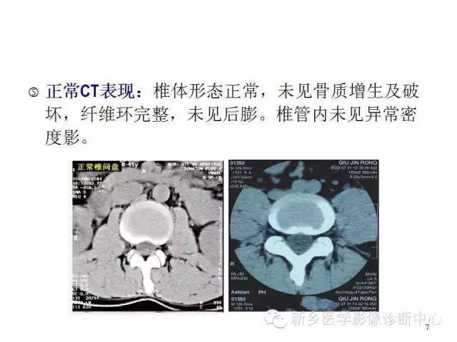 这样诊断“腰椎间盘突出”才更专业 这样诊断“腰椎间盘突出”才更专业