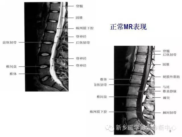 这样诊断“腰椎间盘突出”才更专业 这样诊断“腰椎间盘突出”才更专业