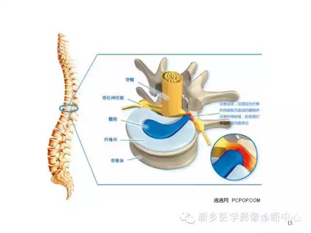 这样诊断“腰椎间盘突出”才更专业 这样诊断“腰椎间盘突出”才更专业