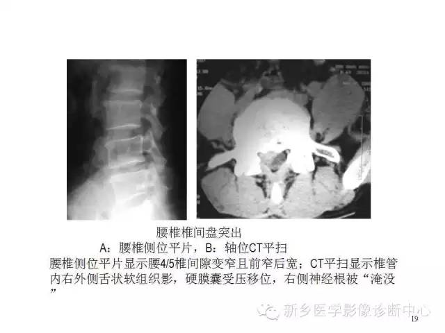 这样诊断“腰椎间盘突出”才更专业 这样诊断“腰椎间盘突出”才更专业