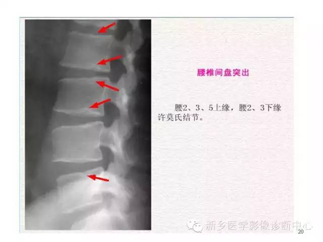 这样诊断“腰椎间盘突出”才更专业 这样诊断“腰椎间盘突出”才更专业