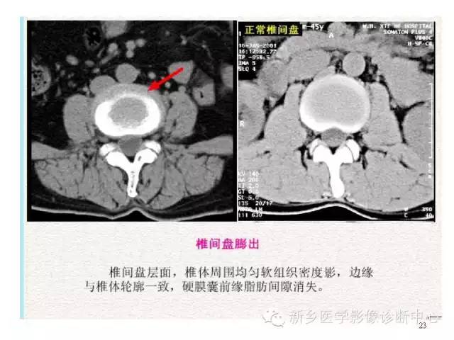 这样诊断“腰椎间盘突出”才更专业 这样诊断“腰椎间盘突出”才更专业