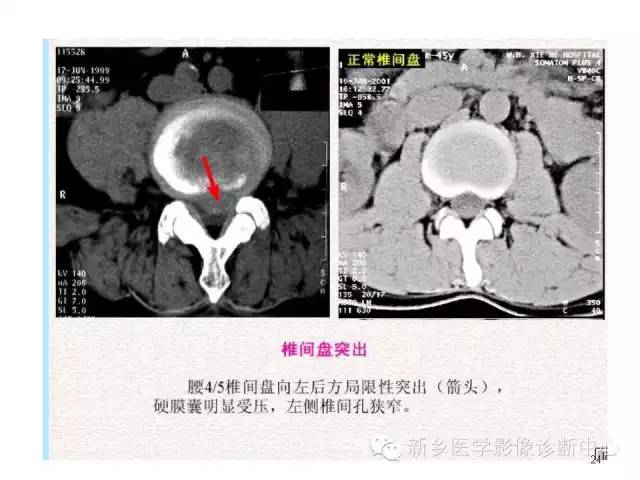 这样诊断“腰椎间盘突出”才更专业 这样诊断“腰椎间盘突出”才更专业