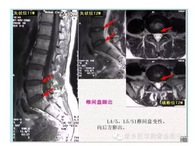 这样诊断“腰椎间盘突出”才更专业 这样诊断“腰椎间盘突出”才更专业
