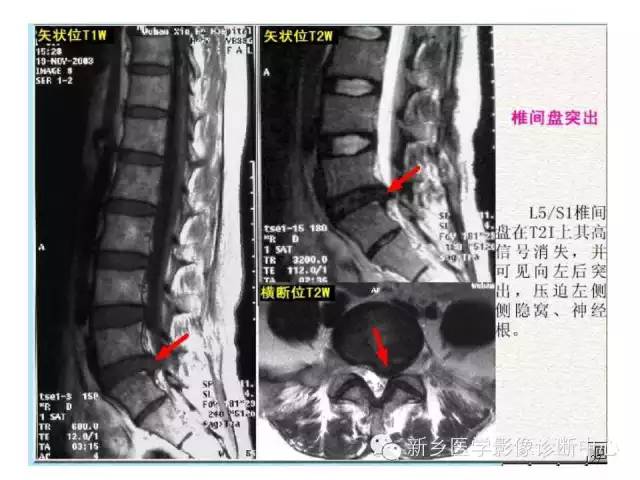 这样诊断“腰椎间盘突出”才更专业 这样诊断“腰椎间盘突出”才更专业