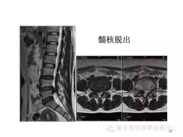 这样诊断“腰椎间盘突出”才更专业 这样诊断“腰椎间盘突出”才更专业