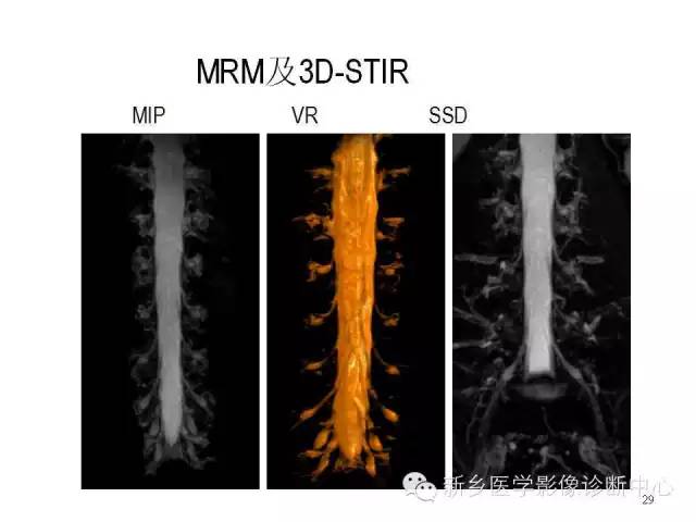 这样诊断“腰椎间盘突出”才更专业 这样诊断“腰椎间盘突出”才更专业