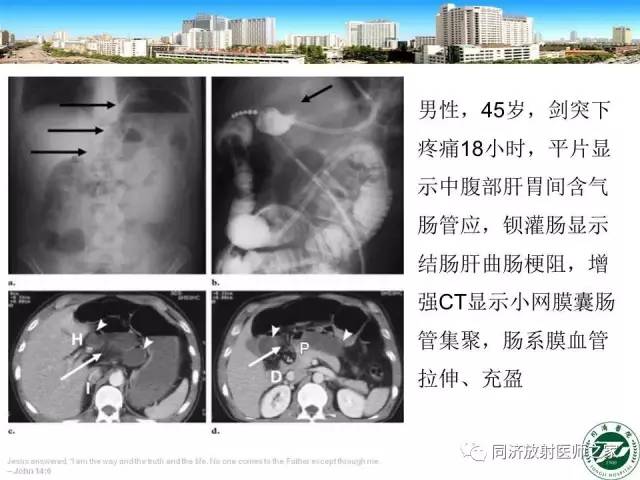 【PPT】内疝的CT诊断