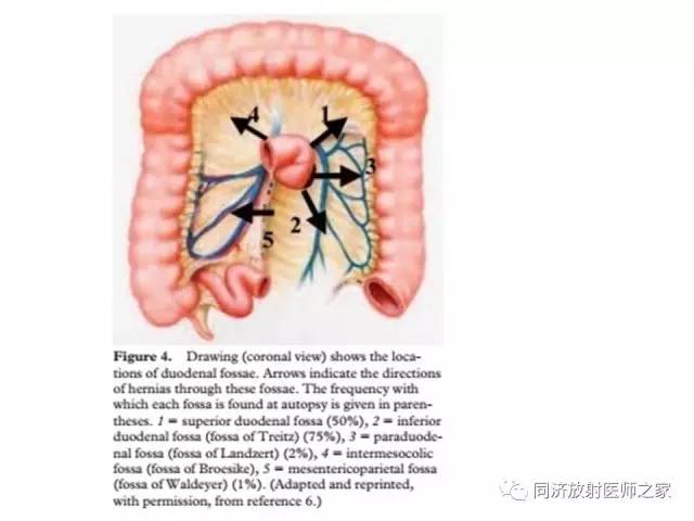 【PPT】内疝的CT诊断
