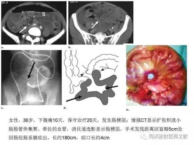 【PPT】内疝的CT诊断
