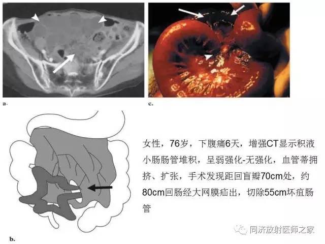 【PPT】内疝的CT诊断