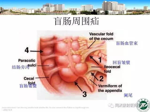【PPT】内疝的CT诊断