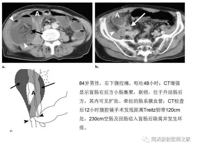 【PPT】内疝的CT诊断