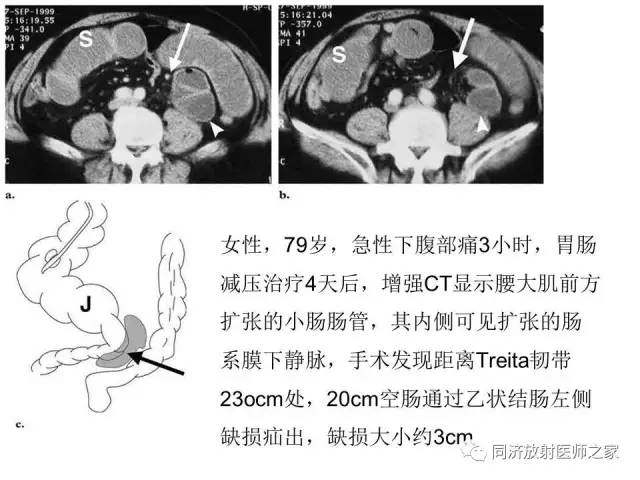 【PPT】内疝的CT诊断