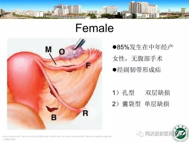 【PPT】内疝的CT诊断
