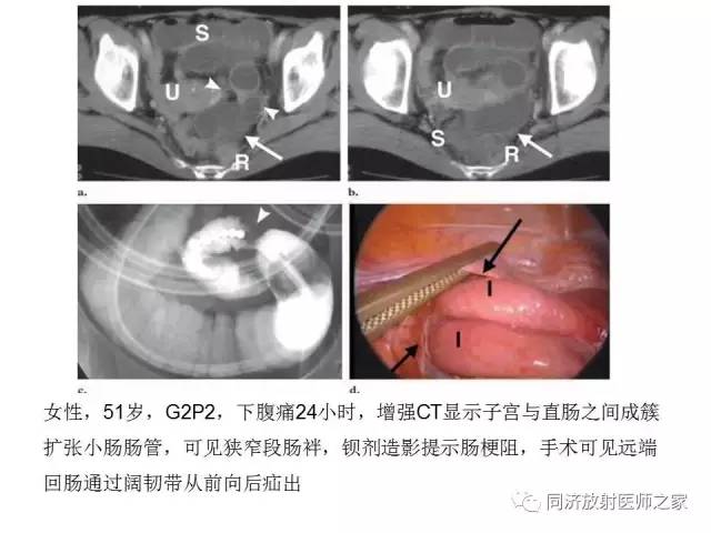 【PPT】内疝的CT诊断