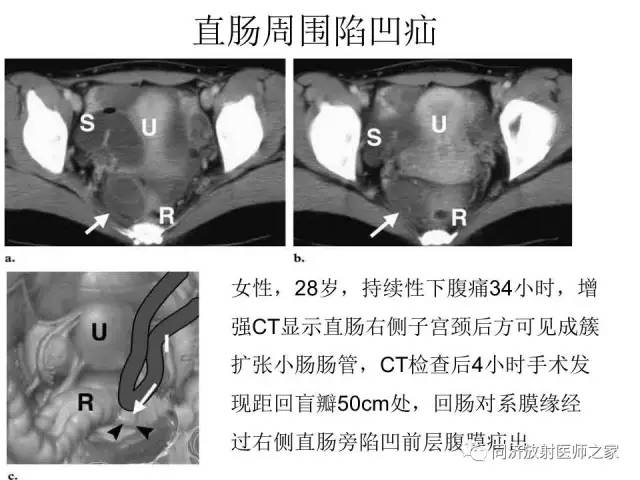 【PPT】内疝的CT诊断