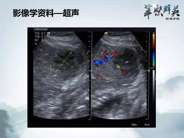 【病例】肝淋巴瘤1例CT影像表现