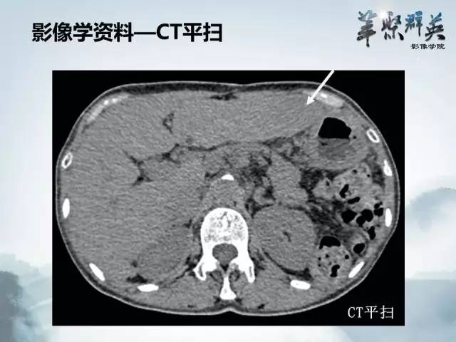 【病例】肝淋巴瘤1例CT影像表现