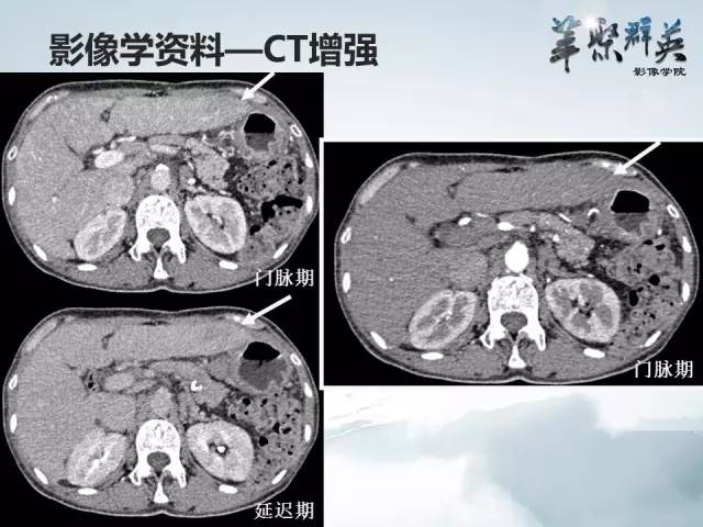 【病例】肝淋巴瘤1例CT影像表现