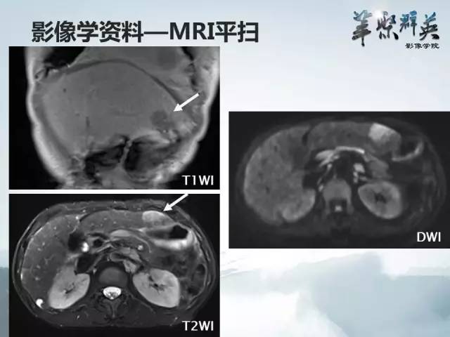 【病例】肝淋巴瘤1例CT影像表现