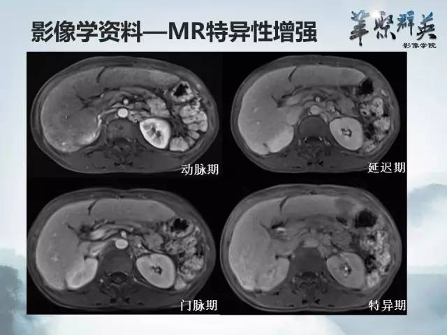 【病例】肝淋巴瘤1例CT影像表现