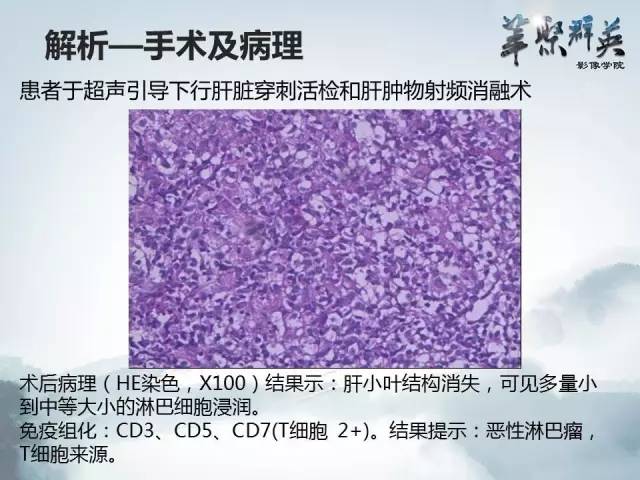 【病例】肝淋巴瘤1例CT影像表现