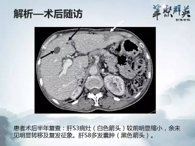 【病例】肝淋巴瘤1例CT影像表现