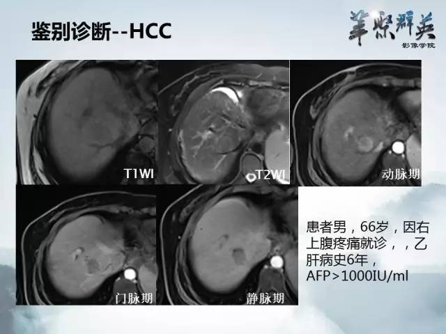 【病例】肝淋巴瘤1例CT影像表现