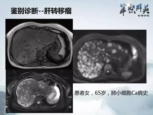 【病例】肝淋巴瘤1例CT影像表现