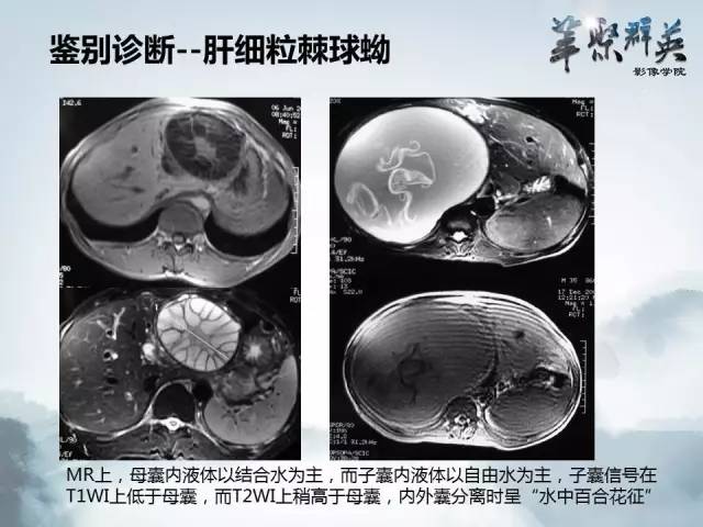 【病例】肝淋巴瘤1例CT影像表现