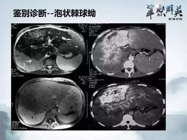 【病例】肝淋巴瘤1例CT影像表现