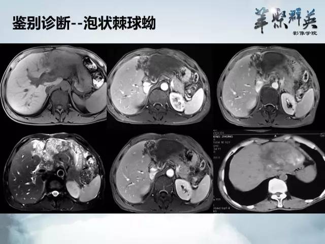 【病例】肝淋巴瘤1例CT影像表现