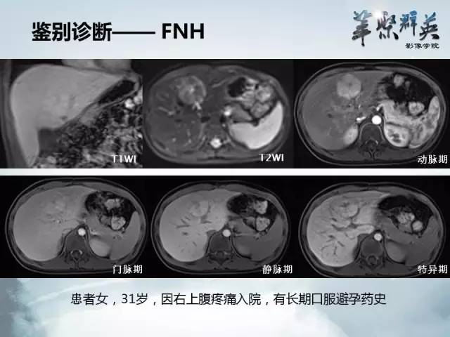 【病例】肝淋巴瘤1例CT影像表现