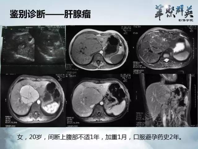 【病例】肝淋巴瘤1例CT影像表现