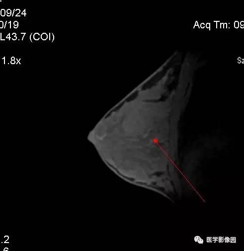 【病例】左乳纤维腺瘤1例MR 【病例】左乳纤维腺瘤1例MR