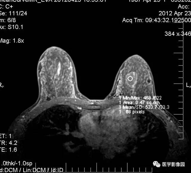 【病例】左乳纤维腺瘤1例MR 【病例】左乳纤维腺瘤1例MR