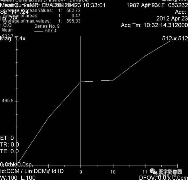【病例】左乳纤维腺瘤1例MR 【病例】左乳纤维腺瘤1例MR