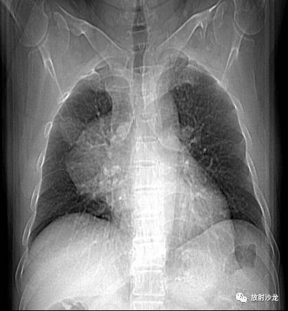 【病例】易误诊为畸胎瘤的胸腺囊肿一例CT