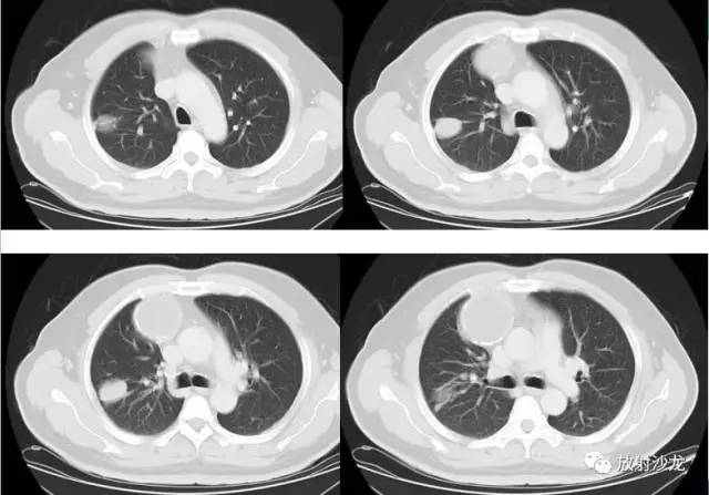 【病例】易误诊为畸胎瘤的胸腺囊肿一例CT