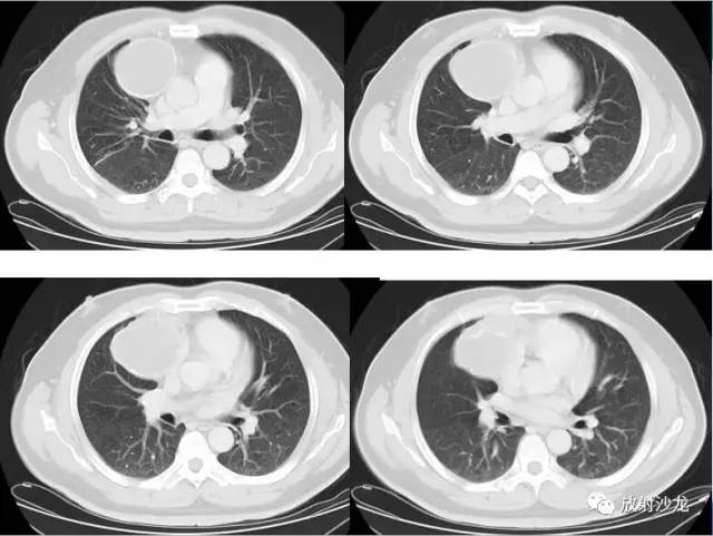 【病例】易误诊为畸胎瘤的胸腺囊肿一例CT