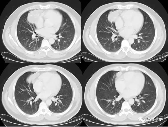 【病例】易误诊为畸胎瘤的胸腺囊肿一例CT